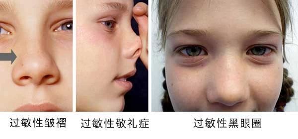 過敏性鼻炎會(huì)讓孩子變傻？！家長該如何應(yīng)對